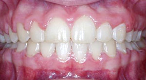 Case 1 Mouth After