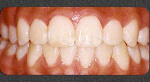 Case 2 Mouth After