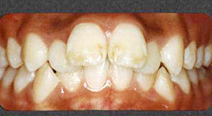 Case 2 Mouth Before