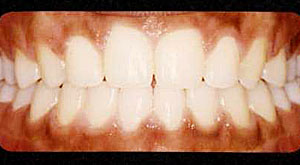 Case 3 Mouth After