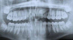 Case 4 Mouth Before