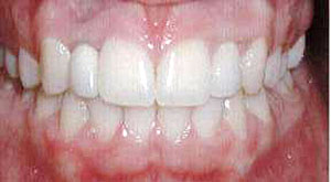 Case 5 Mouth After