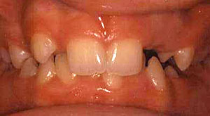 Case 5 Mouth Before